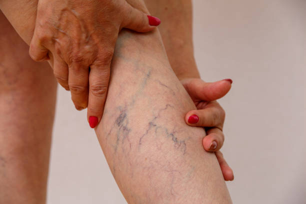 varicose_veins_treatment